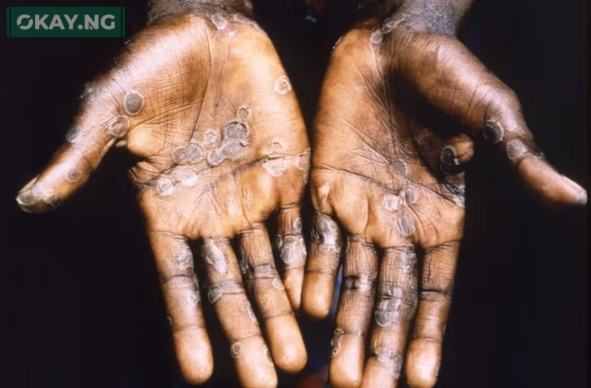 NCDC Nigeria Records 39 Confirmed Cases of Mpox • Okay.ng